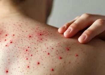 Vigilancia epidemiológica estricta y una respuesta rápida ante casos sospechosos.