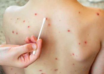 Detectan dos casos de sarampión en Playa del Carmen; serían los primeros del año en Quintana Roo