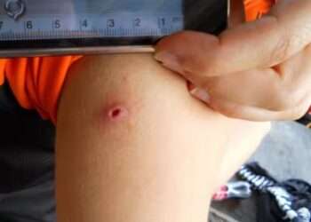 Casos de miasis humana en Quintana Roo: alertan por brotes sin registro